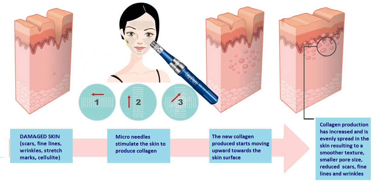 Electric Microneedle Pen Scars Wrinkles Skin Instrument